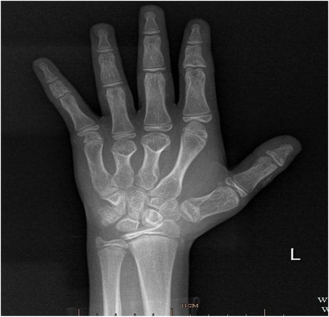 This diagnostic image is an anteroposterior (AP) X-ray of the left hand of a pediatric patient, demonstrating the skeletal anatomy including carpal bones, metacarpals, and phalanges. The primary pathological finding is brachydactyly, characterized by the disproportionate shortening of the third (middle) and fourth (ring) digits. This shortening is most prominent in the metacarpals and phalanges of these digits relative to the second and fifth fingers. The carpal bones are clustered at the wrist, and open growth plates (epiphyseal plates) are visible at the distal radius, ulna, and across the metacarpal and phalangeal joints, consistent with a juvenile skeleton. Such skeletal manifestations, particularly short fourth metacarpals, are classic clinical signs of Albright Hereditary Osteodystrophy (AHO), often seen in Pseudohypoparathyroidism (PHP). The image serves as an educational example of how hand radiography can assist in the diagnostic workup of metabolic and genetic endocrine disorders.