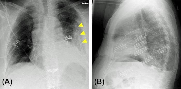 This figure presents two diagnostic chest X-rays demonstrating the surgical management of severe thoracic trauma. Image (A) is an anteroposterior (AP) view showing extensive, significantly dislocated serial rib fractures on the left side, involving ribs 1 through 11. Several ribs exhibit multiple fracture lines creating free-floating segments, characteristic of a 'flail chest' or 'floating rib' pathology. The yellow arrows highlight the lateral areas of significant displacement where the physiological contour of the rib cage is lost. Image (B) is a post-operative lateral X-ray showing the results of surgical stabilization via osteosynthesis. Radiopaque metallic hardware, including specialized plates and screws, is visible on ribs 4 through 7. This internal fixation has restored the physiological contour and structural stability of the thorax. The images illustrate the clinical progression from acute flail chest deformity to post-surgical stabilization, emphasizing that selective osteosynthesis of key segments can successfully stabilize the entire chest wall and improve respiratory mechanics.