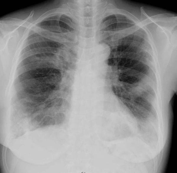 This diagnostic image is a posterior-anterior (PA) chest x-ray showing significant pulmonary pathology. The primary finding is widespread air-space consolidation manifesting as increased opacity, predominantly localized within the right upper lung field and the left lower lung field. Within these consolidated regions, air bronchograms are clearly visible, appearing as dark, tubular air-filled bronchi outlined by the surrounding high-density fluid or tissue. The mediastinal contour appears stable, and the cardiac silhouette is partially obscured by the adjacent consolidation. While the radiographic pattern is classically suggestive of multi-lobar bacterial pneumonia, in this clinical context, it represents pulmonary metastasis from a grade II chondrosarcoma. The image serves as an educational example of how metastatic disease can radiographically mimic infectious consolidation and the importance of the air bronchogram sign in identifying alveolar filling processes.