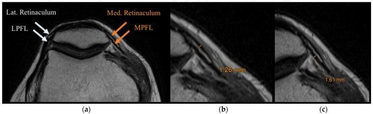 This diagnostic image consists of three axial MRI slices (a-c) of the human knee, focusing on the patellofemoral joint anatomy. Panel (a) provides a labeled overview of the medial and lateral stabilizers. On the lateral side, the lateral retinaculum is shown as a superficial layer, with the lateral patellofemoral ligament (LPFL) located deeper and indicated by white arrows. On the medial side, the medial retinaculum and the medial patellofemoral ligament (MPFL) are identified by orange arrows. Panels (b) and (c) provide magnified views of the medial compartment to demonstrate biometric thickness measurements. In (b), the medial retinaculum is measured at 1.26 mm. In (c), the MPFL is measured at 1.61 mm. The images highlight the distinct layered morphology of these fascial and ligamentous structures, which appear as low-signal (dark) bands against the adjacent tissues. This visualization is clinically relevant for assessing patellar stability, ligamentous tears, or chronic remodeling in conditions such as patellar dislocation or patellofemoral pain syndrome.