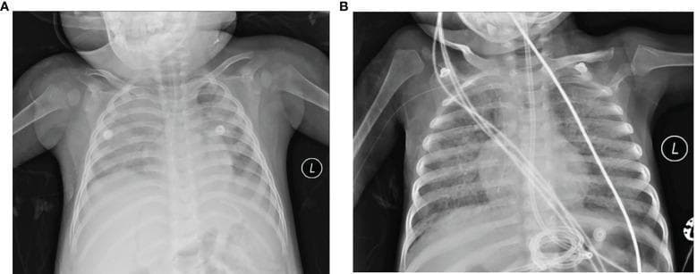 Anteroposterior (AP) chest X-ray radiographs of two pediatric cases demonstrating severe pulmonary pathology in the acute phase of fatal pneumonia. Image (A) shows Case 1, exhibiting thickened, fuzzy lung markings and diffusely reduced light transmittance (increased opacity) in the left lung, resulting in blurring of the left costophrenic angle and diaphragm. The right lung displays unevenly reduced transmittance with patchy infiltrates. Image (B) shows Case 2, presenting with diffuse parenchymal changes and multiple high-density shadows across both lung fields. Visible abnormalities include irregular areas indicative of bronchiectasis and cavitation, particularly prominent in the right middle lobe, alongside small air bubble emphysema. Both images show medical support devices, including ECG leads and external tubing, consistent with a pediatric intensive care unit (PICU) setting. These visuals illustrate the radiological progression and severe lung damage associated with complex pulmonary infections in immunocompromised or critically ill children.