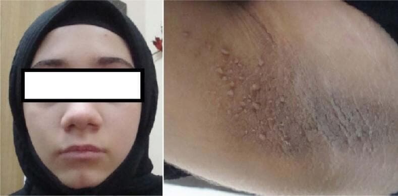 Two-panel clinical photograph displaying the phenotypic characteristics of a patient with Type A insulin resistance syndrome. The left panel shows a frontal view of the face, appearing largely unremarkable except for mild facial fullness. The right panel is a close-up image of the axillary region, demonstrating classic features of acanthosis nigricans. Key visual findings in the axilla include significant hyperpigmentation and skin thickening with a velvety, verrucous, or 'leathery' texture. Multiple small, flesh-colored to light-brown pedunculated papules consistent with skin tags (acrochordons) are visible, scattered across the hyperpigmented area. These skin changes are indicative of severe hyperinsulinemia and resultant hyperkeratosis and papillomatosis. The content is suitable for medical education regarding endocrine-related dermatological manifestations and clinical signs of systemic insulin resistance.