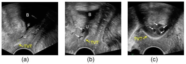 Pelvic floor sonography images demonstrating the management of recurrent stress urinary incontinence using a combination of a Tension-free Vaginal Tape (TVT) and a bulking agent (Bulkamid). Image (a) is a sagittal view showing the bladder (B) and urethra (U) under straining. It reveals proximal urethral funneling (F) and a TVT positioned too distally, failing to provide support. Image (b) shows the same sagittal view following the injection of bulking agent depots (white arrows). The depots are positioned between the bladder neck and the TVT, effectively closing the urethral lumen during straining to restore continence. Image (c) provides an axial view of the urethra, illustrating four hypoechoic bulking agent depots (white arrows) arranged circularly around the urethral lumen to achieve coaptation. The echogenic TVT (yellow arrow) is visible in its relation to the stabilized urethral structure. These images illustrate the use of functional ultrasound to assess implant positioning and surgical outcomes in urogynecology.