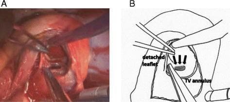 This composite image consists of an intraoperative clinical photograph (A) and a corresponding anatomical line diagram (B) demonstrating the surgical repair of a ventricular septal rupture (VSR). The view is from a right atrial approach after a right atrial oblique incision. In Figure A, surgical forceps and retractors are shown manipulating cardiac tissue to expose the ventricular septum. In Figure B, the anatomical landmarks are clearly labeled, including the tricuspid valve (TV) annulus and a detached portion of the tricuspid valve leaflet. Three black arrows in the diagram point to the site of the ventricular septal rupture, which is located in the basal posterior part of the ventricular septum, immediately posterior to the tricuspid valve annulus. The detachment of the tricuspid valve leaflet is a key surgical maneuver used here to improve visualization and access to the septal defect. This material illustrates complex cardiac surgical anatomy and the transatrial approach for post-infarct VSR repair, a critical procedure in cardiothoracic surgery.
