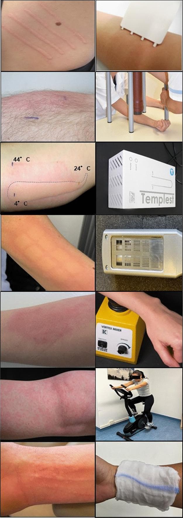 A multi-panel clinical photograph grid demonstrating standardized provocation tests and resulting skin manifestations for Chronic Inducible Urticaria (CIndU). The left column displays various cutaneous reactions on the volar forearm, including: linear wheals and flares characteristic of symptomatic dermographism; a localized erythematous response to temperature testing (marked with 4 C to 44 C gradients); grid-like macular erythema following solar provocation; diffuse edematous plaques from vibratory testing; and punctate, folliculocentric wheals suggestive of cholinergic urticaria. The right column illustrates the corresponding diagnostic modalities and tools, including: a plastic FricTest device for mechanical friction; a weight-rod suspension system for delayed pressure urticaria; the TempTest electronic temperature gradient device; a hand-held UVA/UVB light source for solar urticaria; a laboratory vortex mixer for vibratory angioedema; a static bicycle ergometer for cholinergic urticaria provocation; and a wet towel application for aquagenic urticaria testing. This collection serves as a dermatological guide for identifying subtype-specific wheal morphology and the clinical application of standardized provocation protocols.