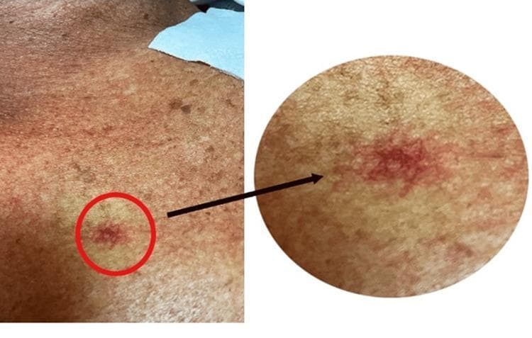 This clinical photograph displays a spider angioma located on the anterior chest wall. The visual consists of a wide-angle view of the skin and a circular magnified inset highlighting the vascular lesion. The spider angioma (also known as spider telangiectasia or nevus araneus) is characterized by a central, prominent red punctum from which small, tortuous capillary vessels radiate outward, mimicking the legs of a spider. The surrounding skin appears tanned and mottled with secondary sun damage and various small hyperpigmented macules. This finding is clinically significant as a cutaneous marker often associated with hyperestrogenic states, such as chronic liver disease (cirrhosis) or pregnancy. The lesion demonstrates blanching upon central pressure, a key diagnostic feature of this vascular malformation. This image is suitable for medical education regarding the physical examination of dermatologic signs of systemic disease and hepatology-related cutaneous manifestations.