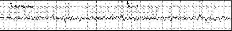 This diagnostic image is a continuous rhythm strip (ECG trace) illustrating ventricular fibrillation, a life-threatening cardiac arrhythmia. The waveform is characterized by rapid, chaotic, and disorganized electrical activity. There is a total absence of identifiable P waves, QRS complexes, and T waves. The baseline is highly irregular, showing undulating oscillations with variable amplitudes and frequencies, consistent with the coarse ventricular fibrillation pattern. Annotated labels 'Initial Rhythm' and 'Point 1' indicate specific chronological markers during the clinical event recorded by emergency medical services. This tracing serves as a classic educational example of a shockable cardiac arrest rhythm requiring immediate defibrillation. It highlights the loss of coordinated ventricular contraction and the resulting hemodynamic collapse associated with this arrhythmia.