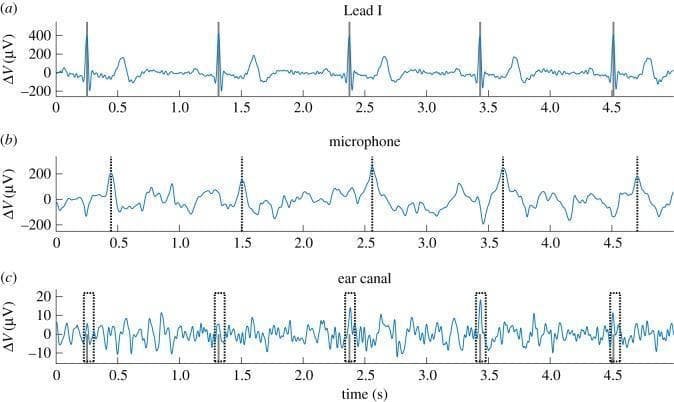 This Comparison Chart illustrates the synchronization of standard and alternative physiological signals for R-wave detection. The image consists of three vertically aligned time-series plots over a 5-second interval. Subplot (a) shows a standard Lead I Electrocardiogram (ECG) recorded from the arms, exhibiting clear P-QRS-T complexes with an R-wave amplitude range from -200 μV to +500 μV. Subplot (b) displays a mechanical plethysmogram recorded via an in-ear MEMS microphone, where periodic maxima represent arterial pulse arrivals in the ear canal. Subplot (c) shows the 'ear-ECG' signal with a significantly lower amplitude (-15 to +20 μV) and higher noise floor. Vertical markers demonstrate the temporal relationship between the standard R-wave (Lead I) and the corresponding signals in the ear canal. This comparison highlights the educational concept of using co-located mechanical sensors (microphone) to define a search window for identifying low-SNR electrical signals (ear-ECG) in wearable health-monitoring applications.