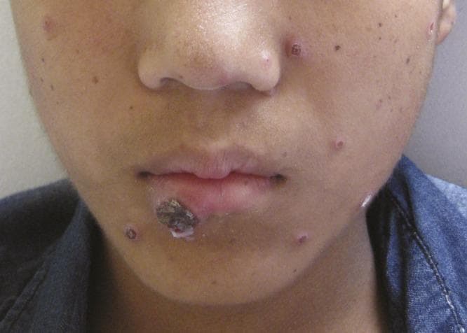 Clinical photograph of a young male patient's face demonstrating disseminated cutaneous lesions characteristic of fungal infection, specifically Histoplasmosis. The primary visible pathology consists of multiple small, discrete, erythematous papules distributed across the cheeks, nose, and chin. Several of these papules exhibit central umbilication or shallow ulceration with a necrotic or hemorrhagic center and a raised, red rim. A larger, more complex lesion is situated on the vermilion border of the lower lip, presenting as a prominent, irregular, brownish-black crusted plaque with associated whitish exudate, suggesting secondary ulceration or necrosis. The presentation illustrates the cutaneous manifestations of systemic fungal disease in the context of immunocompromise or severe systemic infection. This visual material is pedagogically useful for dermatology and infectious disease education regarding the morphology of miliary or disseminated fungal skin signs.