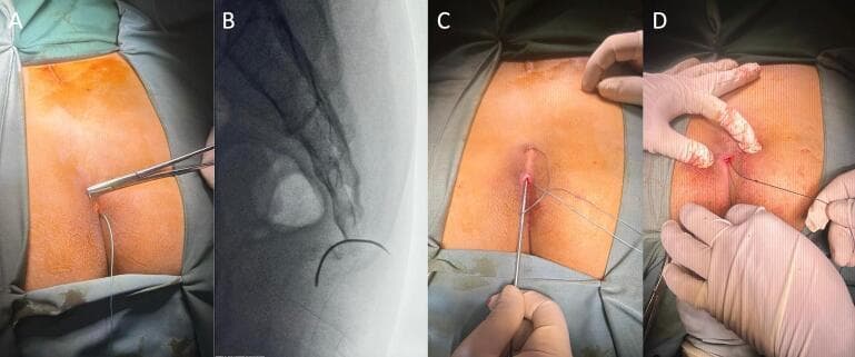 A multi-panel clinical and diagnostic composite illustrating a minimally invasive surgical fixation of a sacrococcygeal fracture-dislocation. Panels A, C, and D are clinical photographs showing the intraoperative procedure in a patient in the prone position. Panel A demonstrates a small, approximately 1 cm midline incision in the sacrococcygeal region with a surgical needle holder positioned at the entry site. Panel C shows a surgical probe or guide being used to facilitate a subcutaneous figure-of-eight suture technique, while Panel D shows the final tensioning and tying of the non-absorbable suture. Panel B is a lateral fluoroscopic (X-ray) image of the sacrococcygeal spine, showing a radiopaque surgical needle passing intraosseously to bridge the fracture gap between the sacrum and the displaced coccygeal segments. The composite demonstrates the sequence of a 'mini-open' reduction and internal fixation (ORIF) designed to stabilize the coccyx while minimizing soft tissue trauma.
