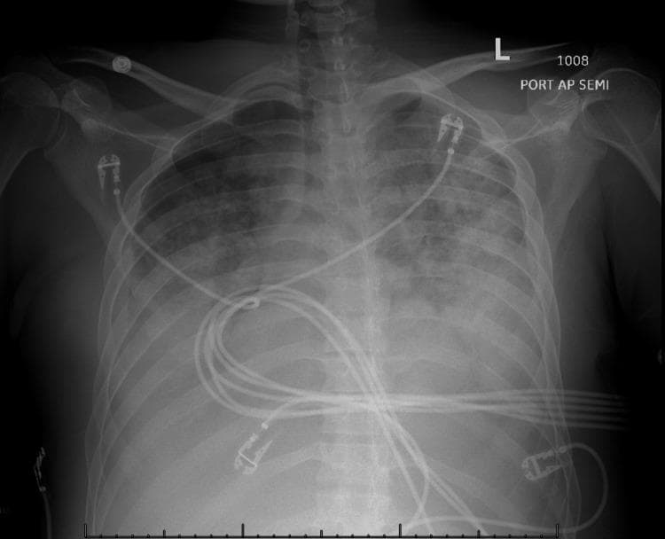 This diagnostic image is a portable anteroposterior (AP) chest X-ray demonstrating significant pulmonary pathology. The radiograph shows diffuse, bilateral patchy opacities throughout both lung fields, consistent with alveolar consolidation or interstitial fluid accumulation. There is a prominent increase in radiographic density and indistinctness of the pulmonary vasculature, particularly in the upper lobes, indicating pulmonary vascular congestion and cephalization. These findings are characteristic of pulmonary edema secondary to volume overload. Several medical devices are visible, including multiple external electrocardiogram (ECG) leads and cables overlying the thoracic cavity. The cardiac silhouette appears partially obscured by the overlying opacities. This image serves as a teaching tool for recognizing the radiographic manifestations of acute pulmonary congestion and parenchymal opacification in a critically ill patient, likely in the context of multi-organ dysfunction or renal failure.