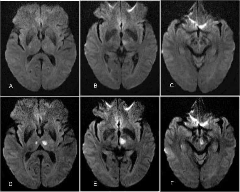 Diagnostic Image: A series of six axial diffusion-weighted MRI (DWI) scans labeled A through F, demonstrating the evolution of an acute ischemic stroke. Panels A-C represent the initial presentation, showing subtle, ill-defined hyperintense lesions in the left paramedian thalamus and the midline midbrain region, suggesting early diffusion restriction. Panels D-F represent follow-up imaging on the third day of illness, revealing more localized, well-defined, and intense hyperintense signals (diffusion-limited) in the left paramedian thalamus and the left side of the midbrain. This specific distribution of bilateral/paramedian thalamic and midbrain involvement is characteristic of an Artery of Percheron (AOP) infarction, a rare anatomical variant where a single arterial trunk supplies both paramedian thalami. The sequence illustrates the radiographic progression of cytotoxic edema and the consolidation of an infarct within a specific vascular territory, suitable for intermediate to advanced medical learners studying neurology and neuroradiology.