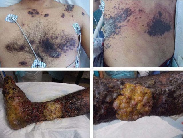 A composite of clinical photographs showing severe cutaneous manifestations of AIDS-associated Kaposi's sarcoma. The upper panels display the patient's torso, featuring widespread, multifocal skin lesions. These lesions vary from small, purplish-red macules to large, confluent plaques. Some plaques exhibit a hyperkeratotic, thickened, and rough texture, primarily distributed across the chest, upper abdomen, and lateral trunk. The lower panels focus on the right lower extremity, demonstrating an advanced, fungating tumor mass on the medial calf. This approximately 10 x 10 cm lesion is lobulated and exophytic, showing mixed yellow purulent exudate and dark necrotic areas. The surrounding skin of the lower leg and foot appears severely edematous with signs of secondary infection, dry gangrene, and extensive ulceration. This imagery illustrates the clinical presentation of disseminated Kaposi's sarcoma in the context of profound immunosuppression and high HIV viral load, highlighting both the classic multifocal plaques and rare, aggressive exophytic variants.