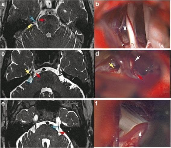 This composite medical image presents a comparison between pre-operative axial MRI scans (a, c, e) and corresponding intra-operative clinical photographs (b, d, f) illustrating neurovascular conflict (NVC) in cases of trigeminal neuralgia. The MRI images demonstrate the spatial relationship between the trigeminal nerve (TGN, blue arrows) and adjacent vascular structures, primarily the superior cerebellar artery (SCA, red arrows) and other vessels (yellow arrows) in the cerebellopontine angle. The intra-operative views provide direct visualization of these structures during microvascular decompression (MVD) surgery. The series highlights clinical discrepancies where routine MRI might suggest arterial compression that is later identified intra-operatively as non-contacting (white arrow gap in b), compression by venous structures (white arrow in d), or arterial compression that was subtle on imaging (white arrow in f). This comparison serves as an educational tool for neurosurgical planning, emphasizing the importance of identifying the Root Entry Zone (REZ) and distinguishing between arterial and venous compression in the management of trigeminal nerve syndromes.