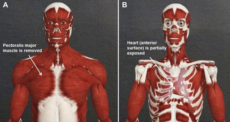 This comparative anatomical diagram displays two stages of a virtual dissection of the human head, neck, and thorax, highlighting the transition from superficial to deep structures. Image A (left) demonstrates the superficial musculature, prominently showing the pectoralis major muscles covering the anterior chest wall, along with the sternocleidomastoid, deltoids, and facial muscles. Image B (right) illustrates a deeper dissection plane where the pectoralis major and segments of the rib cage have been removed. This exposure reveals the underlying thoracic cavity, specifically showing the anterior surface of the heart (pericardium) and the internal skeletal framework, including the clavicles and individual ribs. Both images maintain consistent visualization of the head and neck musculature, such as the masseter and orbicularis oculi, as well as the biceps brachii in the upper limbs. The content is designed for medical education to teach thoracic anatomy, spatial relationships between the musculoskeletal system and internal organs, and the logic of surgical or anatomical dissection layers.