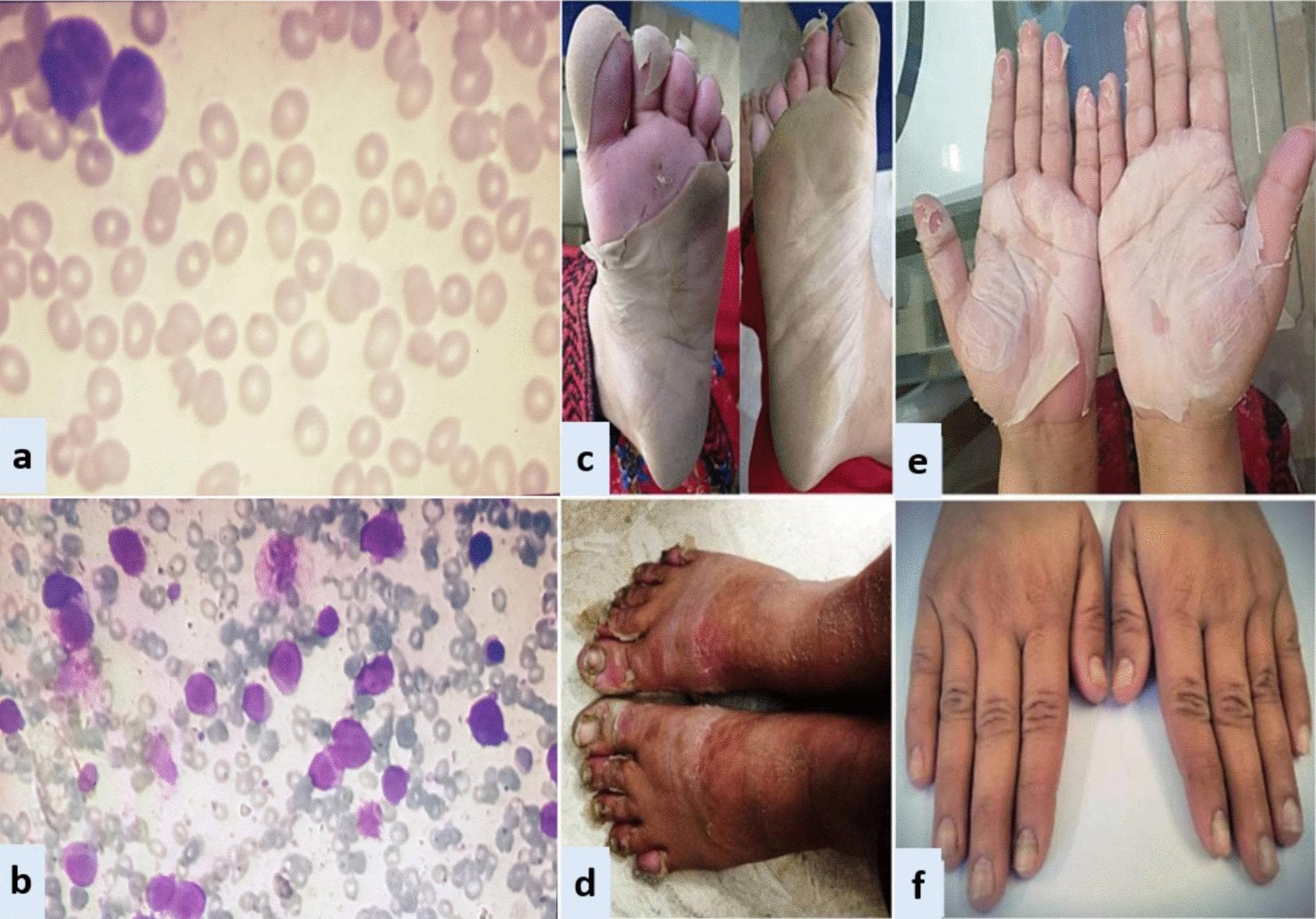 A composite medical image featuring microscopic and clinical findings associated with Acute Promyelocytic Leukemia (APL) and its treatment complications. Panels (a) and (b) show Wright-Giemsa stained light microscopy images: (a) a peripheral blood smear with scattered red blood cells and rare large atypical promyelocytes, and (b) a hypercellular bone marrow aspirate demonstrating a dense infiltration of blast cells with high nuclear-to-cytoplasmic ratios and prominent purple staining. Panels (c) through (f) illustrate dermatological manifestations consistent with exfoliative dermatitis and onychomadesis likely secondary to All-Trans Retinoic Acid (ATRA) therapy. (c) and (d) show the plantar surfaces of the feet with extensive, sheet-like desquamation and underlying erythema. (e) displays bilateral palmar exfoliation with large flaps of peeling epidermis. (f) shows the dorsal aspect of both hands with nail bed changes including yellow discoloration and signs of proximal nail plate separation (onychomadesis). The educational focus is the correlation between hematological malignancy and rare cutaneous drug reactions during induction chemotherapy.