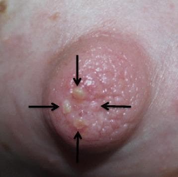 This clinical photograph shows a close-up view of a human female nipple exhibiting trauma secondary to breastfeeding. The nipple is visibly erythematous and has a rough, pebbled texture. Several small, discrete, raised, fluid-filled vesicles (blisters) are located on the nipple surface, particularly near the apex. These lesions are approximately 2-4 mm in diameter, yellowish-white in color, and indicated by four black arrows in the image. The surrounding areolar skin appears unremarkable without significant inflammation or secondary skin lesions. Clinically, this presentation illustrates mechanical skin trauma, specifically suction-induced friction blisters resulting from high intra-oral vacuum and the use of nipple shields during lactation. This image serves as an educational example of maternal breastfeeding complications and the physiological impact of infant latch mechanics on maternal tissue integrity.