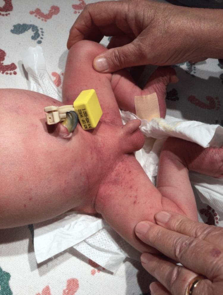 This clinical photograph displays the lower abdomen and perineal region of a newborn infant. A non-blanching petechial rash is visible, characterized by numerous pinpoint, dark red to purple macules. The lesions are most densely concentrated within the inguinal folds and the perineal area, with scattered distribution extending onto the lower torso and medial aspects of the thighs. The infant is positioned on a white clinical diaper featuring a footprint pattern. Key neonatal features include a stump of the umbilical cord secured with a yellow and tan plastic umbilical clamp and a tan adhesive bandage on the right ankle. An examiner's gloved hands are visible, retracting the legs to demonstrate the extent of the eruption in the skin folds. This presentation is significant for neonatal dermatology and hematology, often requiring investigation for congenital infections (TORCH), neonatal alloimmune thrombocytopenia, or sepsis.