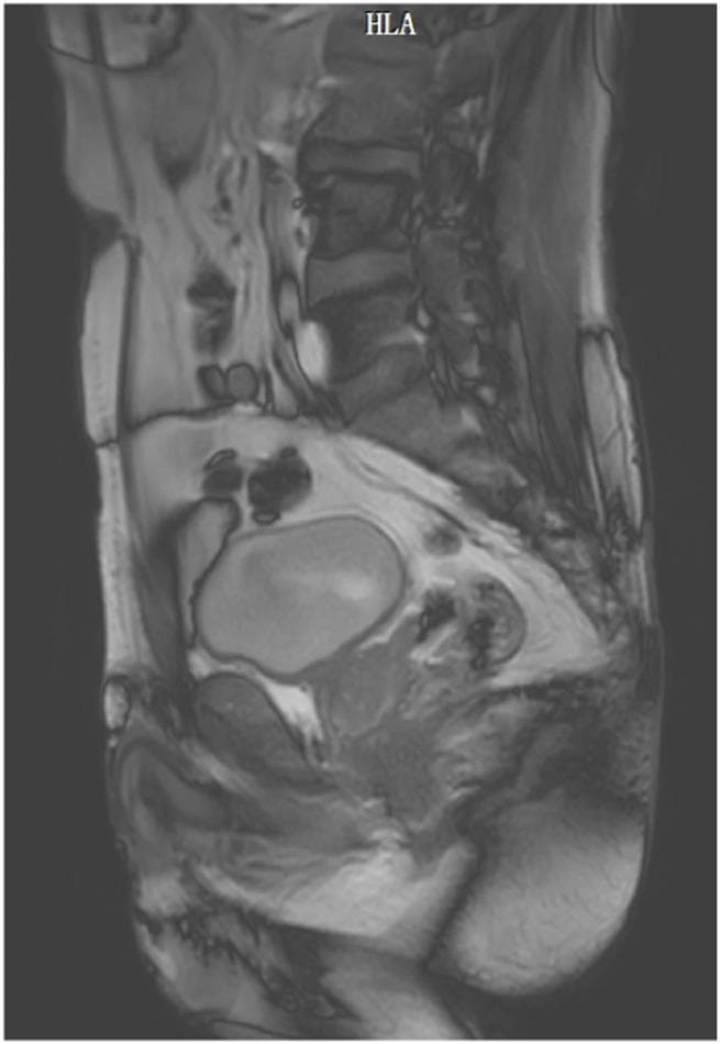 This diagnostic image is a midsagittal dynamic MRI of the pelvic region, captured using a BTFE sequence. The image clearly visualizes the pelvic floor anatomy and surrounding musculoskeletal structures. Key anatomical landmarks include the lower lumbar vertebrae, sacrum, and coccyx posteriorly. Centrally, the bladder is seen as a well-defined sac-like structure with a homogenous signal, situated anterior to the rectum. The levator ani muscle complex is visible as a muscular band extending toward the coccyx, providing support to the pelvic organs. The pelvic floor musculature, subcutaneous fat (appearing as high-intensity signal), and fascial planes between organs are delineated. This dynamic imaging modality is utilized to assess the functional movement of the pelvic organs during maneuvers such as the Valsalva or Kegel exercises, allowing for the clinical evaluation of conditions like pelvic organ prolapse, urinary incontinence, and defecation dysfunction by measuring changes in the anorectal angle (ARA) and retrovesical angle (RVA).