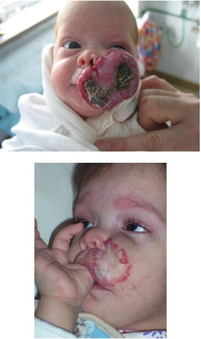 This comparison chart consists of two clinical photographs showing the progression and involution of an infantile hemangioma (IH) on the upper lip and left cheek of a pediatric patient. The first image depicts the patient at 1 month of age with a large, exophytic, bright red vascular tumor characterized by a lobulated, raised surface and central areas of dark crusting/necrosis, suggesting ulceration. The lesion involves the philtrum and extends onto the left malar region. The second image shows the same patient at age 2 years, demonstrating significant involution of the hemangioma. The previously large mass has regressed into a flatter, depressed scar-like area with central pallor/fibrofatty replacement and a peripheral telangiectatic red rim. This timeline illustrates the natural history of proliferative infantile hemangiomas, transitioning from an active growth phase with potential complications like ulceration to the late involution stage. The images are highly relevant for dermatology and pediatrics regarding vascular birthmark management and clinical observation.