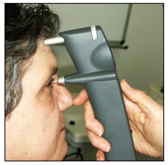 This clinical photograph demonstrates the application of an iCare rebound tonometer on a human subject. The device is a handheld, pistol-shaped instrument with a dark gray plastic body designed for measuring intraocular pressure (IOP). The image shows the device's operational alignment: a superior cylindrical forehead rest is placed against the patient's brow for stabilization, while the lower housing contains a thin, white, magnetized probe positioned perpendicular to the central cornea. The probe is shown in near-contact with the eye, illustrating the rebound tonometry principle where a lightweight probe momentarily impacts the cornea. The device measures the induction current created by the probe's deceleration and rebound velocity to calculate IOP. This diagnostic tool is significant in ophthalmology for glaucoma screening as it is rapid, portable, and does not require topical anesthesia or fluorescein, making it particularly useful for pediatric and non-compliant patients.