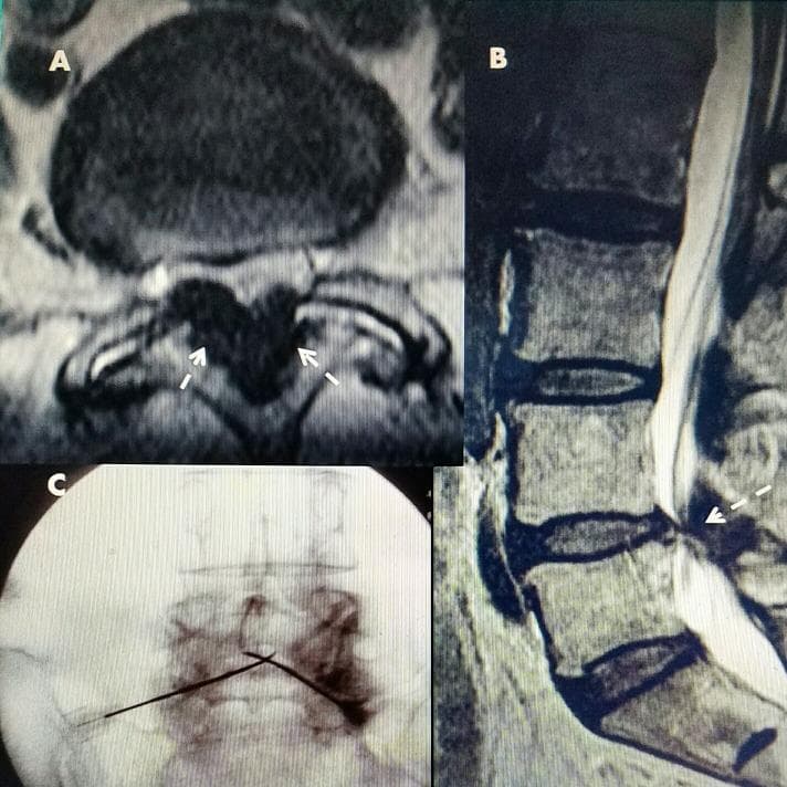 This composite figure illustrates L4-L5 lumbar spinal stenosis and a corresponding radiofrequency (RF) treatment procedure. Panel A is an axial CT image showing marked bilateral ligamentous hypertrophy (white arrows), appearing hypointense and significantly narrowing the spinal canal from the posterior aspect. Panel B is a sagittal T2-weighted MRI demonstrating posterior compression of the thecal sac at the L4-L5 level caused by ligamentous stenosis. Panel C is an anteroposterior (AP) fluoroscopic image showing the percutaneous placement of two RF electrodes. The electrodes are positioned with an inferior-lateral to superior-medial trajectory, meeting within the posterior canal targeting the hypertrophied ligamentum flavum. This instructional sequence highlights the diagnostic radiological findings of soft tissue spinal stenosis and the subsequent targeted interventional approach for decompression using RF thermal ablation.