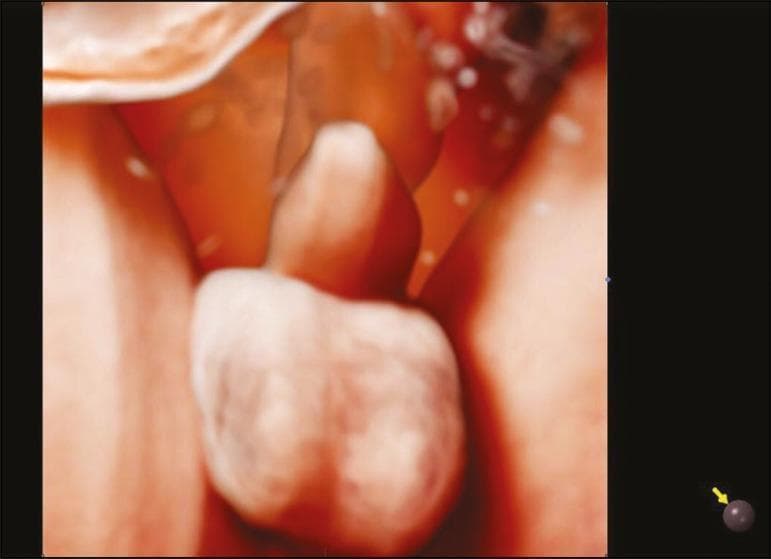 This diagnostic image is a 3D Realistic Vue ultrasound rendering of a male fetus's external genitalia at 30 weeks of gestation. The anatomical structures include the penis, positioned superiorly, and the scrotum, which appears as a distinct, bilobed sac-like structure located inferiorly. The rendering utilizes advanced light and shadow modeling, with a virtual light source at the 11 o'clock position and a 270-degree rotation to enhance the three-dimensional perception of depth and morphology. The image demonstrates normal fetal development in the third trimester, focusing on the clear identification of male anatomical landmarks. The clinical significance of this modality lies in its ability to provide high-definition anatomical details during prenatal screening, facilitating the confirmation of fetal sex and the assessment of structural development in the pelvic region.