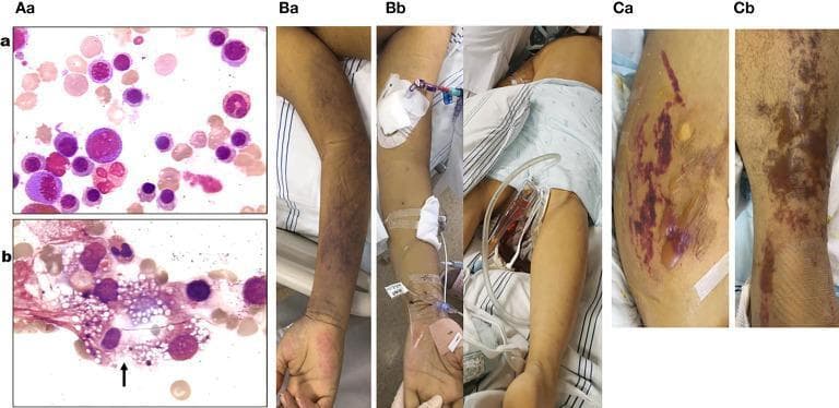 This composite medical image includes bone marrow smears and clinical photographs documenting the progression of a systemic illness, likely Parvovirus B19 infection. Diagnostic Images (Aa, Ab): Bone marrow smears (400x magnification) demonstrate a transition from hyperplastic marrow with active erythropoiesis (Aa) to a significant decrease in erythroblast density and maturation inhibition (Ab). Image Ab prominently displays a phagocytic cell containing numerous vacuoles and cellular debris (black arrow), indicative of hemophagocytic syndrome. Clinical Photographs (Ba-Cb): Serial photographs show evolving cutaneous manifestations. Initial findings (Ba, Bb) demonstrate blue-purple ecchymosis and diffuse mottling on the limbs and trunk. Later stages (Ca, Cb) reveal progressive purple-red ecchymotic lesions associated with the development of large, strained bullae filled with serous fluid on an erythematous base. The images illustrate the clinical and pathological manifestations of acute aplastic crisis and hemophagocytic lymphohistiocytosis (HLH) within the context of hematologic and infectious disease.