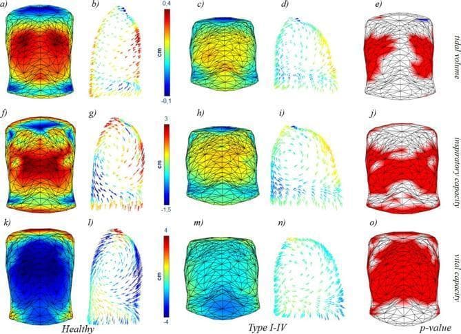 This medical comparison chart utilizes 3D optoelectronic plethysmography data to visualize chest wall dynamics in healthy subjects and patients with Osteogenesis Imperfecta (OI) Types I-IV. The figure is organized into three rows representing different respiratory maneuvers: Tidal Volume (VT), Inspiratory Capacity (IC), and Vital Capacity (VC). Columns display three-dimensional colormaps of surface displacement, arrow plots of motion vectors, and statistical p-value maps. The colormaps (a, f, k for healthy; c, h, m for OI) use a warm-to-cool scale to quantify displacement in centimeters, where red indicates expansion and blue indicates inward movement or less displacement. Healthy subjects demonstrate robust, symmetrical ribcage expansion during inspiration, whereas OI patients exhibit reduced magnitude and altered displacement patterns, particularly in the lower thorax. The arrow plots (b, g, l for healthy; d, i, n for OI) depict the direction and magnitude of trunk motion, highlighting the more vertical and less outward chest wall trajectory in OI patients. Statistical maps (e, j, o) use red to signify regions where healthy subjects have significantly greater average displacement compared to OI Type I-IV patients (p < 0.05), emphasizing widespread respiratory mechanics impairment in the clinical group across all lung volumes.