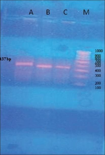 This diagnostic image shows a 1.5% agarose gel electrophoresis result, a common molecular biology technique used in medical genetics and pathology to visualize DNA fragments. The gel contains four lanes labeled A, B, C, and M. Lanes A, B, and C demonstrate single, prominent PCR amplification products of the NPC1L1 gene, specifically a 437 base pair (bp) fragment. These three lanes represent experimental trials conducted at varying annealing temperatures (61.5°C, 60.5°C, and 59.5°C, respectively) to optimize the Polymerase Chain Reaction (PCR) process. The consistent horizontal position of the bands across A, B, and C indicates uniform fragment size. Lane M contains a DNA ladder (marker) with visible increments ranging from 100 bp to 1000 bp, serving as a size reference. The image illustrates the process of verifying specific gene amplification prior to genetic sequencing or restriction fragment length polymorphism (RFLP) analysis for genotype determination.