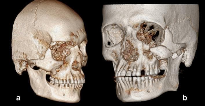 Two 3D computed tomography (CT) reconstructions of the human skull demonstrating different classifications of zygomaticomaxillary complex (ZMC) fractures based on the Zingg criteria. Image 'a' displays a Type B 'Mono-bloc' fracture, characterized by a single, complete displacement of the malar bone. There is visible separation at all primary articulation sites, including the zygomaticofrontal suture, infraorbital rim, and zygomatic arch, moving the zygoma as a single unit. Image 'b' illustrates a Type C 'Multi-fragment' or comminuted fracture. This image shows extensive fragmentation of the midface, particularly involving the lateral orbital wall, floor of the orbit, and the zygomatic arch. Multiple small, disorganized bone fragments are visible within the orbital cavity and maxillary region, indicating high-energy trauma with significant structural disruption compared to the mono-bloc type. These images serve as a diagnostic reference for maxillofacial surgeons to differentiate between stable single-fragment breaks and complex comminuted injuries requiring different surgical fixation strategies.