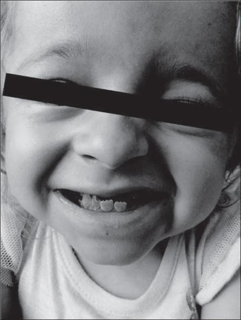 A monochrome clinical photograph of a 7-year-old child illustrating significant craniofacial and dental anomalies. The image demonstrates a prominent mandibular protrusion (prognathism) resulting in a Class III malocclusion. Key visible dental features include an anterior crossbite and an 'undershot' jaw where the mandibular incisors are positioned anterior to the maxillary teeth. The teeth themselves show structural abnormalities consistent with dentin dysplasia, characterized by irregular morphology, rounded or worn incisal edges, and atypical spacing. The facial skeleton displays structural disharmony, which is accentuated by the child's smile. This visual serves as a clinical example of the secondary skeletal and dental manifestations of dentin dysplasia and its impact on pediatric occlusion and maxillofacial development.