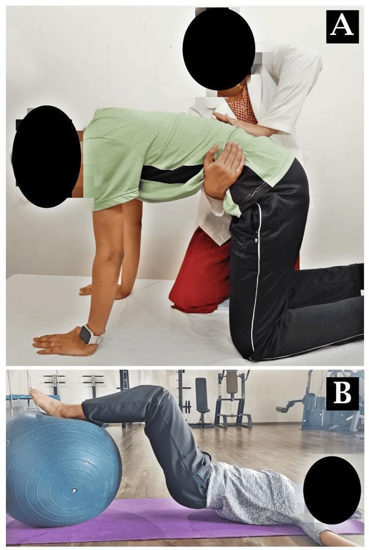 Clinical photograph showing two stages of physiotherapy for sacroiliac joint (SIJ) dysfunction. Panel A demonstrates a manual therapy technique known as mobilization with movement (MWM). A patient is in a quadruped (all-fours) position on a treatment table while a therapist, wearing a white lab coat, applies a manual gliding force to the posterior pelvic/sacroiliac region to facilitate pain-free movement. Panel B illustrates a rehabilitative exercise for core and pelvic stability. The patient is performing a supine bridge on a purple yoga mat with their lower legs and heels resting on a blue Swiss ball (stability ball). This movement combines hip extension and knee flexion to target the gluteal muscles, hamstrings, and lumbopelvic stabilizers. The images serve as educational examples of combined manual and active rehabilitation strategies for managing pelvic girdle pain and improving musculoskeletal function in the lumbosacral region.