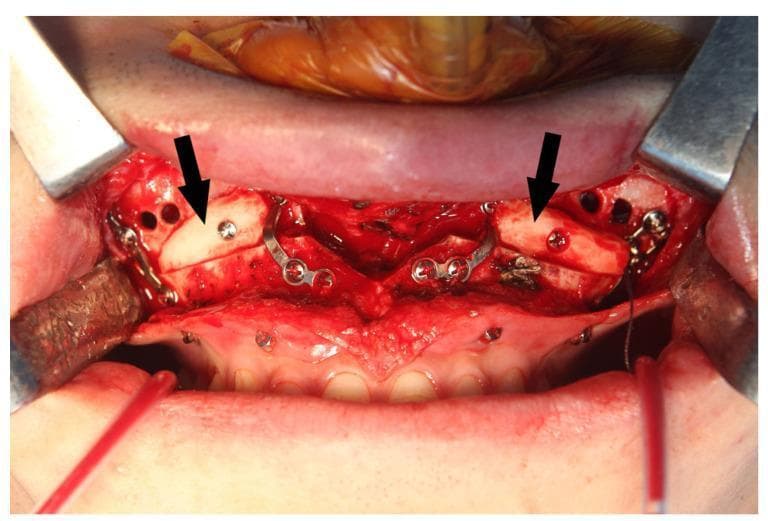An intraoperative clinical photograph showing a Le Fort I osteotomy site in the anterior maxilla during bimaxillary orthognathic surgery. The surgical field is exposed using metal retractors, revealing the maxillary bone superior to the upper dentition. Two autogenous bone blocks (indicated by black arrows) are grafted bilaterally at the maxillary sinus wall gaps to ensure postoperative stability and facilitate sinus drainage. These pale, dense bone grafts are secured into position using titanium osteosynthesis screws. Multiple L-shaped and straight metal fixation plates are visible, bridging the osteotomy lines. Additionally, several small, circular drainage holes are drilled into the anterior maxillary wall, intended for the placement of Maxillary Sinus Vacuum Drainage (MSVD) tubes. The image demonstrates complex maxillofacial reconstruction techniques, highlighting the integration of rigid internal fixation, autogenous grafting, and sinus management protocols.