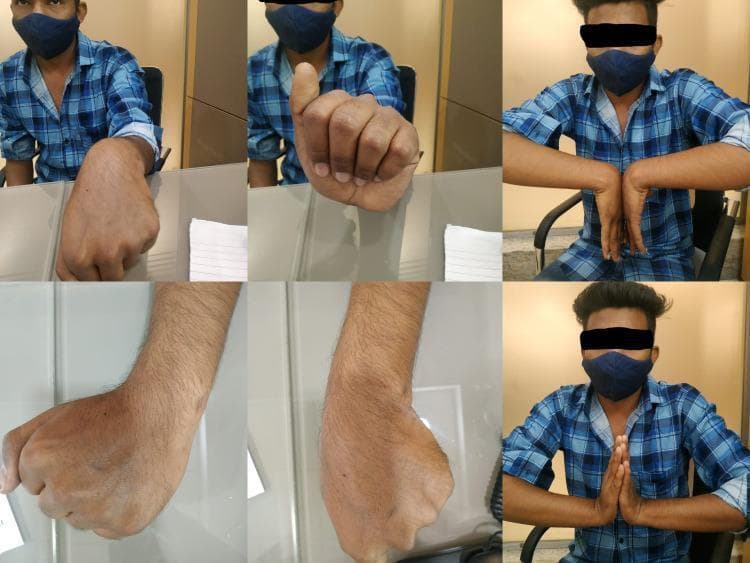 A composite of six clinical photographs demonstrating the range of motion (ROM) of the wrist and hand in a patient six months post-surgery for a wrist injury. The top row shows the patient performing active wrist movements: the first frame displays a neutral wrist position with a closed fist; the second shows a fist with thumb extension; and the third demonstrates bilateral wrist palmar flexion in a 'reverse Phalen' maneuver. The bottom row provides detailed views: the left and middle frames are close-up lateral and dorsal photographs of the wrist during active palmar flexion and dorsiflexion, showing healthy skin integrity with minimal scarring and no significant edema. The final frame depicts bilateral wrist extension with palms pressed together (Prayer sign). This series evaluates postoperative functional recovery, specifically volar tilt, radial inclination, and the modified Mayo wrist score, illustrating successful restoration of joint mobility and grip strength following surgical intervention.