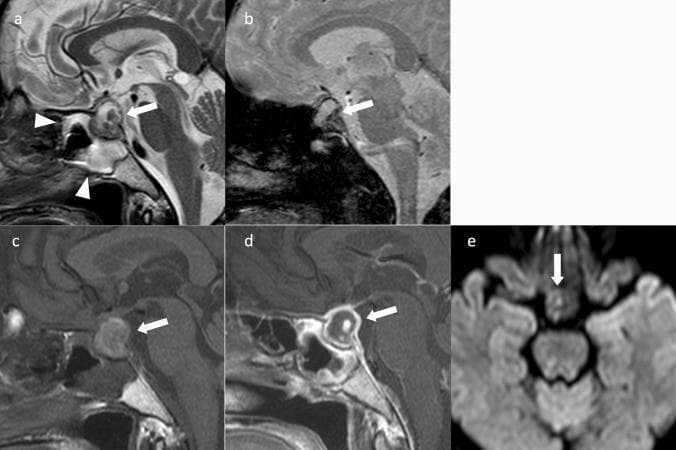 This composite of brain MRI sequences illustrates pituitary apoplexy in a female patient. Panel (a), a sagittal T2-weighted image, shows a heterogeneous mass in the sella turcica (arrow) with mixed hyperintense and hypointense signals. Prominent mucosal thickening is visible in the adjacent sphenoid sinus (arrowheads), a common sign of acute apoplexy. Panel (b), a sagittal T2*-weighted image, reveals a significant hypointense region within the mass (arrow), highly suggestive of acute hemorrhage due to magnetic susceptibility effects. Panel (c) shows a mildly hyperintense signal on sagittal non-contrast T1-weighted imaging, while panel (d) demonstrates peripheral ring enhancement of the sellar mass (arrow) on contrast-enhanced T1-weighted imaging, indicating a central area of necrosis or hemorrhage without vascular supply. Panel (e), an axial diffusion-weighted image (DWI), shows the mass as iso-intense (arrow). These diagnostic findings are classic for pituitary neuroendocrine tumor (PitNET) apoplexy, characterized by sudden intratumoral hemorrhage and infarction.