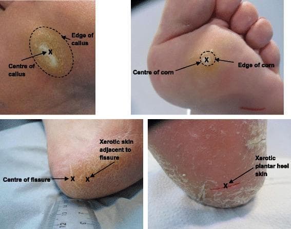 A composite of four clinical photographs demonstrating common hyperkeratotic skin lesions of the human foot and specific measurement landmarks for dermatological study. Top-left: A plantar callus on the metatarsal region, showing a broad area of yellowish, thickened stratum corneum with a dotted line marking the edge and an 'X' at the center. Top-right: A plantar corn (heloma), appearing as a smaller, more circumscribed, and deeply nucleated hyperkeratotic lesion compared to the callus. Bottom-left and Bottom-right: Clinical manifestations of xerosis and heel fissures. The skin shows significant dryness, scaling, and deep linear cracks (fissures). Annotations include 'X' marks at the center of fissures and adjacent xerotic skin to indicate measurement sites for biophysical parameters like hydration, elasticity, and texture. These images illustrate the distinction between localized pressure-induced lesions (calluses/corns) and generalized epidermal barrier dysfunction (xerosis/fissures) in podiatric medicine.