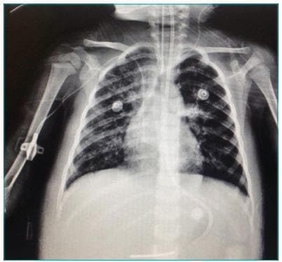 Anteroposterior (AP) chest radiograph of a pediatric patient undergoing high-frequency oscillatory ventilation (HFOV) for Acute Respiratory Distress Syndrome (ARDS). The image displays bilateral, diffuse interstitial and alveolar infiltrates with a ground-glass appearance, indicating residual inflammatory or infectious processes. There is a visible asymmetric opacity in the right hemithorax, though an overall improvement is noted compared to typical acute ARDS presentation. Key medical devices are present: a centrally positioned endotracheal tube (ET) for mechanical ventilation, a peripherally inserted central catheter (PICC) or peripheral line entering through the right arm, and circular ECG electrodes on the anterior chest wall. An enteric tube (nasogastric or orogastric) is seen extending toward the stomach. Lung volumes appear adequately maintained without significant atelectasis. The mediastinum is midline, and the osseous structures including the ribs and clavicles are intact and normally oriented for age. This diagnostic image serves as an educational example of monitoring pulmonary improvement and device placement in a critical care setting.