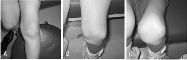 Type: Clinical photographs illustrating habitual patellar dislocation during knee flexion. Anatomical Region: Left knee joint. Description: A series of three monochrome clinical images (A, B, and C) demonstrating the progression of patellar tracking as the knee moves from extension into flexion. Image A shows the knee in extension, where the patella maintains a seemingly normal anatomical alignment within the trochlear groove. Image B captures the knee at approximately 90 degrees of flexion, revealing a clear lateral subluxation of the patella. Image C shows the knee at 120 degrees of flexion, where the patella is significantly dislocated laterally, creating a prominent soft tissue protrusion on the lateral aspect of the knee and an abnormal joint contour. Educational Focus: This series demonstrates the clinical manifestation of flexion-dependent patellar instability or habitual dislocation, highlighting how dynamic physical examination is essential when static extension views appear normal. Clinical Relevance: Useful for diagnosing patellofemoral tracking disorders, medial parapatellar instability, or high sulcus angles.