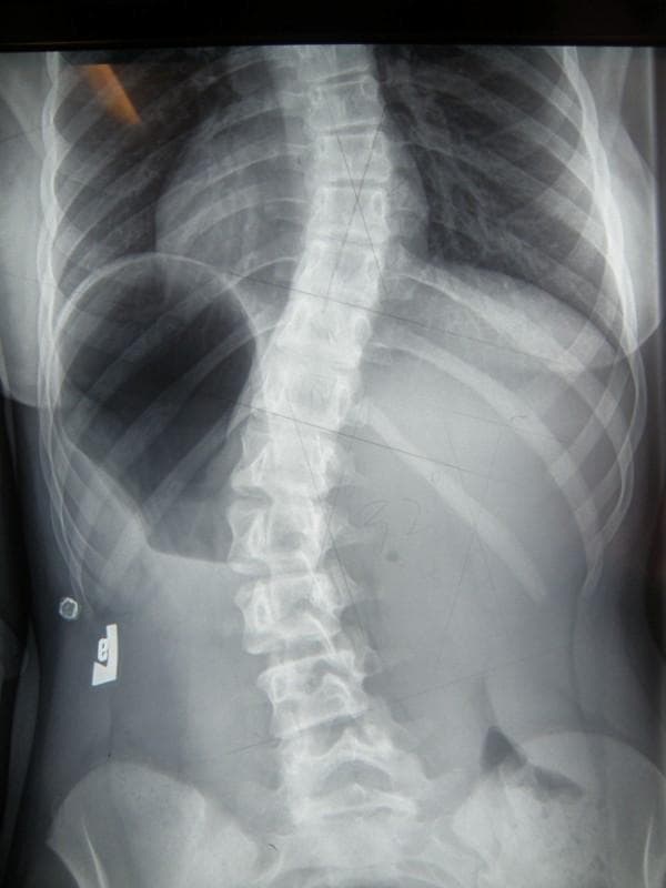 Anteroposterior (AP) x-ray radiography of the spine, primarily focusing on the thoracic and lumbar regions. The diagnostic image reveals a significant S-shaped spinal curvature consistent with double-curve adolescent idiopathic scoliosis. The primary curve is located in the mid-to-lower thoracic region with a rightward lateral convexity (dextroscoliosis). A secondary compensatory curve is observed in the lumbar region with a leftward lateral convexity (levoscoliosis). There is visible rotation of the vertebral bodies toward the convexity of the curves. Secondary skeletal effects include narrowing of the intercostal spaces on the concave sides of the curves and an asymmetric appearance of the rib cage. The lower aspect of the radiograph captures the iliac crests of the pelvis. Faint lines drawn on the film suggest clinical measurement of the Cobb angle for orthopedic assessment. This visual serves as a primary tool for evaluating spinal alignment, determining the degree of deformity, and planning non-operative or surgical treatment protocols in orthopedics and physical therapy.