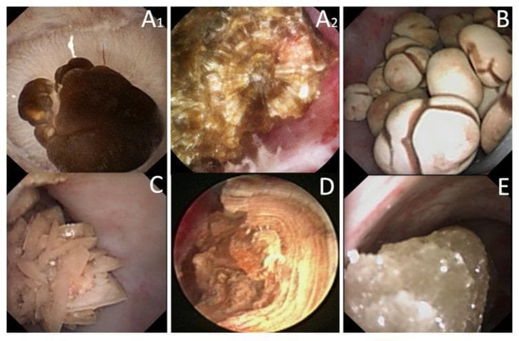 This composite of endoscopic clinical photographs demonstrates the Endoscopic Stone Recognition (ESR) of various nephrolithiasis types. Panel A1 shows a calcium oxalate monohydrate (COM) stone with a characteristic dark-brown, mammillary surface anchored to a renal papilla via Randall's plaque. A2 displays a COM stone transection revealing a radiating crystalline structure originating from a central nucleus. Panel B illustrates COM subtype Id stones with a pale, brownish-yellow budding surface. Panel C depicts calcium oxalate dihydrate (COD) stones, characterized by yellow, spiculated surfaces consisting of aggregated crystals with sharp angles. Panel D shows a uric acid (UA) stone with a smooth, homogeneous orange exterior and a transected view showing concentric laminar organization around a nucleus. Panel E presents a cystine stone, identifiable by its rough, bumpy light brown-yellow surface with a distinctive waxy luster. These images serve as a diagnostic guide for intraoperative identification of stone morphology to inform metabolic etiology and recurrence risk.