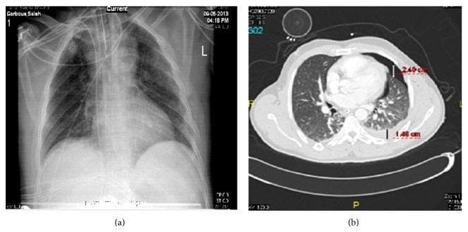 This composite diagnostic image features a side-by-side comparison of a supine chest radiograph (a) and a corresponding axial thoracic CT scan (b) from a trauma patient, demonstrating occult hemopneumothorax. The chest X-ray (a) shows subtle increased opacification in the left lower zone but fails to clearly delineate discrete air or fluid collections. In contrast, the axial CT scan (b) provides definitive visualization of injury. It demonstrates a 2.49 cm anterior pneumothorax, visible as a pocket of air separating the lung from the anterior chest wall, and a 1.46 cm lamellar hemothorax, appearing as a hyperdense fluid collection in the dependent posterior pleural space. Annotated measurements on the CT scan quantify the depth of both the air and fluid stripes. This comparison highlights the clinical significance of CT imaging in identifying 'occult' pleural injuries that are not readily apparent on standard radiography in the setting of blunt chest trauma.
