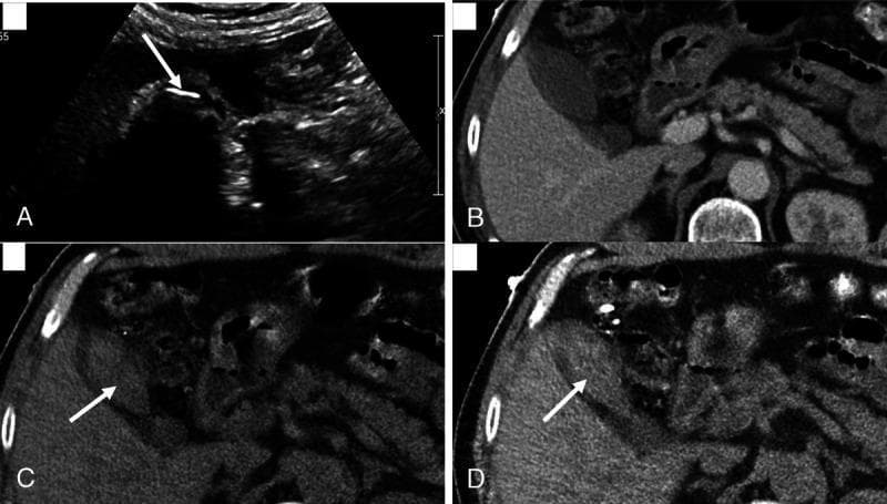 This four-panel image provides a comparison of cholelithiasis (gallstones) across different imaging modalities. Panel A: Abdominal ultrasound displays a gallbladder containing a large, hyperechoic structure (arrow) with a prominent posterior acoustic shadow, diagnostic of a gallstone. Panel B: A standard Portal-Venous Phase (PC) CT scan shows the gallbladder lumen with fluid density, but the stone is iso-attenuating and thus invisible. Panel C: A Virtual Non-Contrast (VNC) reconstruction from Dual-Energy CT (DECT) successfully delineates the stone (arrow), which appears hyperdense relative to the surrounding bile. Panel D: A 50-keV Virtual Monoenergetic Image (VMC) reconstruction further highlights the gallstone (arrow) by enhancing the contrast between the cholesterol-rich stone and the gallbladder fluid. The composite illustrates how specialized DECT reconstructions (VNC and low-keV VMC) can overcome the limitations of conventional CT in detecting radiolucent or iso-attenuating gallstones, approaching the sensitivity of ultrasound for biliary pathology.