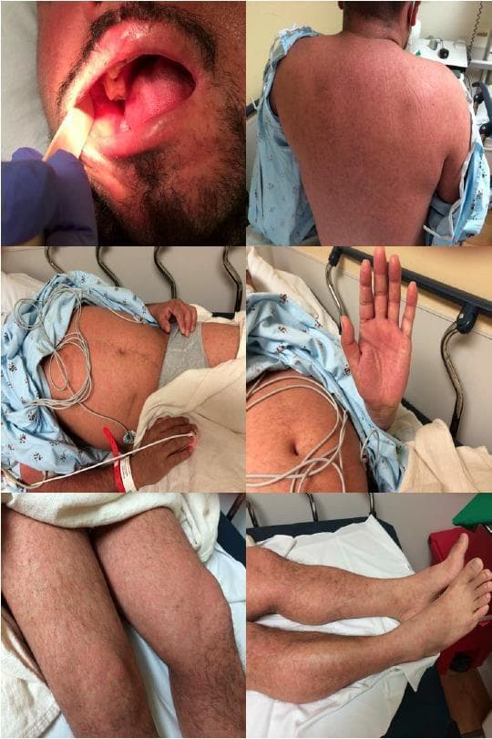 A series of clinical photographs documenting the exanthem and enanthem of measles (rubeola) in an adult male. The oral cavity image demonstrates pathognomonic Koplik spots: tiny, bluish-white or whitish-gray macules resembling grains of sand on an erythematous base, located on the buccal mucosa. The remaining images show a generalized, blanching, erythematous maculopapular rash. This exanthem exhibits a cephalocaudal progression, appearing as numerous discrete macules and papules that have coalesced into larger patches on the back, abdomen, and extremities, including the palms and feet. The presentation illustrates the classic clinical manifestations of a primary measles infection, highlighting the diagnostic importance of the enanthem during the prodromal phase and the characteristic distribution of the subsequent skin eruption for emergency and infectious disease medicine.