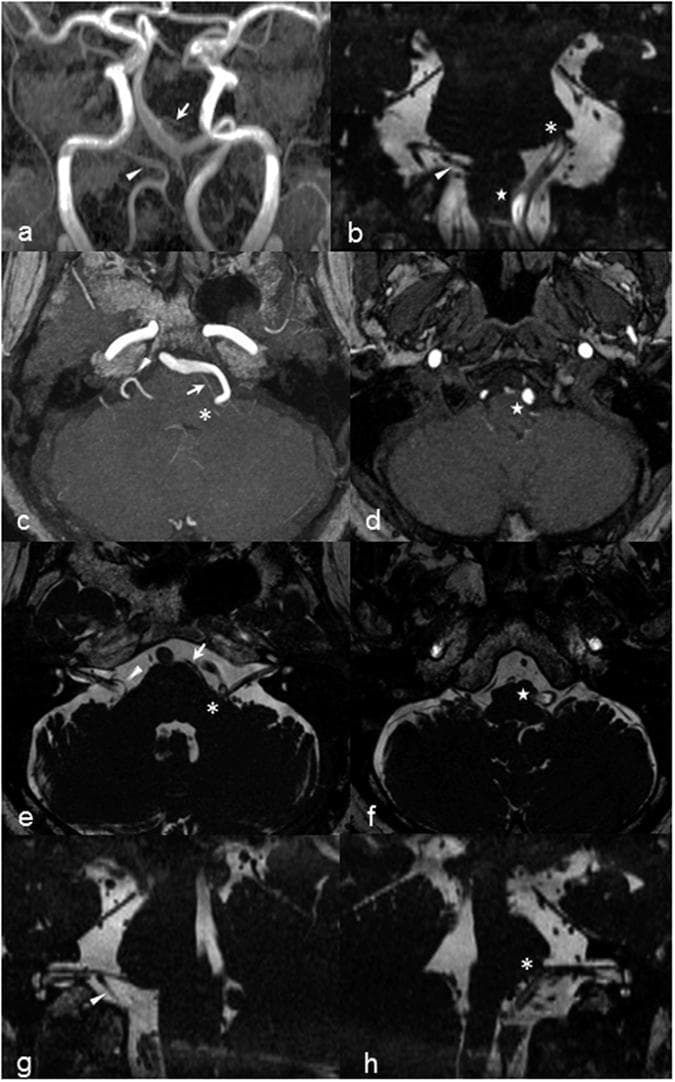 A multi-panel Brain MRI and MRA study demonstrating neurovascular conflict in a patient with left hemifacial spasm. Panel (a) shows a coronal MRA Maximum Intensity Projection (MIP) of dolichoectatic vertebrobasilar arteries. Panels (b), (e), (f), (g), and (h) utilize Constructive Interference at Steady State (CISS) sequences to provide high-resolution anatomical detail. The images highlight vascular compression of the left facial nerve root exit zone (REZ) and the left ventrolateral medulla (VLM). Specifically, the tortuous left vertebral artery (VA) and anterior inferior cerebellar artery (AICA) are seen indenting and displacing the brainstem and cranial nerve origin. Comparative oblique sagittal reconstructions show a normal facial nerve path on the right (panel g) versus pontine distortion and nerve elevation on the left (panel h). Markers identify the left AICA (arrow), right PICA (arrowhead), facial nerve REZ (asterisk), and VLM compression (star). This series illustrates the typical imaging findings of neurovascular compression syndromes where ectatic vessels impinge upon the cisternal segment of cranial nerves.