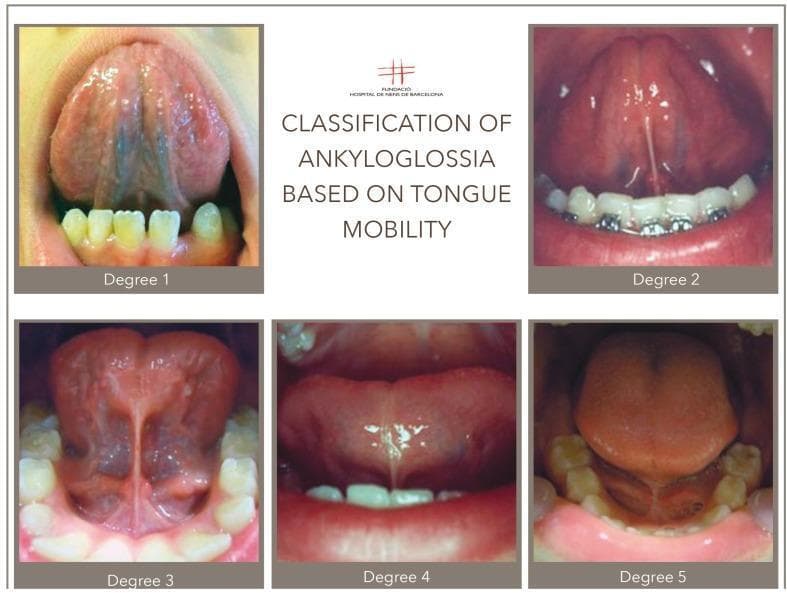 A composite of five clinical intraoral photographs illustrating a classification system for ankyloglossia (tongue-tie) based on lingual mobility and the morphology of the lingual frenulum. The degrees range from 1 to 5, demonstrating progressive variations in frenulum attachment and tongue restriction. Degree 1 shows a thick, restrictive frenulum with visible sublingual vasculature. Degree 2 depicts a thinner, cord-like frenulum with a slight apical cleft on the tongue tip and orthodontic appliances on the mandibular teeth. Degree 3 features a prominent, tight frenulum extending toward the tongue tip, significantly limiting elevation. Degree 4 displays a less fibrous but still restrictive frenulum with a flattened, broad tongue shape. Degree 5 represents a posterior or submucosal type where the tongue base appears heavily attached to the floor of the mouth, resulting in a short, rounded tongue appearance and severely limited protrusion. This educational material serves as a diagnostic guide for dental and oral surgery specialists to assess the severity of hypertrophic lingual frenula before considering surgical interventions like frenectomy.