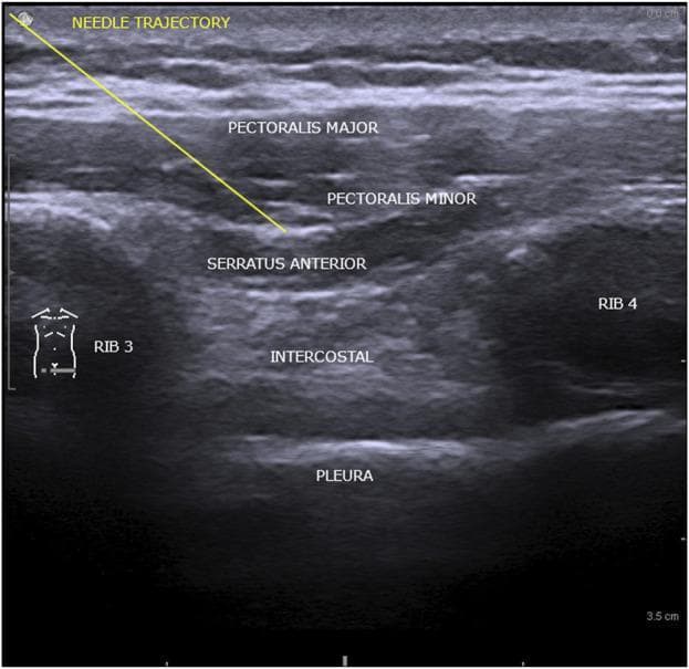 This diagnostic ultrasound image illustrates the regional anatomy involved in the interpectoral (PECS I) and pectoserratus (PECS II) plane blocks. The image displays a cross-sectional view of the anterior chest wall with distinct muscular and osseous landmarks. The Pectoralis Major is the most superficial muscle layer, followed by the Pectoralis Minor. Deep to these is the Serratus Anterior muscle, which sits atop the thoracic cage. Two ribs (Rib 3 and Rib 4) are identified by their hyperechoic anterior surfaces and posterior acoustic shadowing. Between the ribs, the hypoechoic intercostal space is visible, with the pleura appearing as a highly echogenic, horizontal line at the deepest level shown. An annotation line indicates the 'Needle Trajectory,' demonstrating the path through the pectoral muscles toward the fascial plane above the Serratus Anterior. This visual is designed for anesthesia education, specifically targeting ultrasound-guided regional anesthesia for thoracic or breast procedures.
