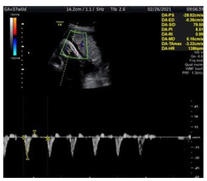A diagnostic ultrasound image showing a color Doppler assessment of the fetal tibial artery in a 37-week fetus diagnosed with intrauterine growth restriction (IUGR). The split-screen display consists of a top panel showing a cross-sectional grayscale view of the fetal leg with a color Doppler box overlaid on the tibial artery, where red and blue hues indicate blood flow direction. A yellow dashed line marks the sampling gate. The bottom panel displays the corresponding spectral Doppler waveform. The waveform shows a high-resistance pulsatile pattern characterized by sharp systolic peaks and a notable pathological finding: reverse flow (diastolic flow dipping below the baseline). On-screen quantitative data indicates a Pulsatility Index (PI) of 8.51, which is above the 95th percentile for gestational age, a resistive index (RI) of 0.99, and a heart rate of 138 bpm. This visual evidence highlights the role of peripheral artery Doppler in monitoring fetal well-being and identifying hemodynamic deterioration.