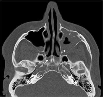 This diagnostic image is a non-contrast axial Computed Tomography (CT) scan of the paranasal sinuses. The scan demonstrates significant pathology in the left paranasal sinuses compared to the right. There is subtotal opacity of the left maxillary sinus, characterized by soft tissue density almost completely filling the sinus cavity, indicative of chronic rhinosinusitis or fluid accumulation. Additionally, the image shows evidence of ethmoidal sinusitis with mucosal thickening and opacification of the ethmoid air cells. In contrast, the right maxillary sinus remains primarily air-filled with minor peripheral mucosal thickening. White arrows indicate areas of significant inflammation and narrowing of the nasal passages. The surrounding bony structures of the sinus walls appear intact, and the mastoid air cells are visible inferiorly. This clinical imaging is essential for evaluating chronic sinus disease, which may be associated with systemic conditions such as Yellow Nail Syndrome (YNS).