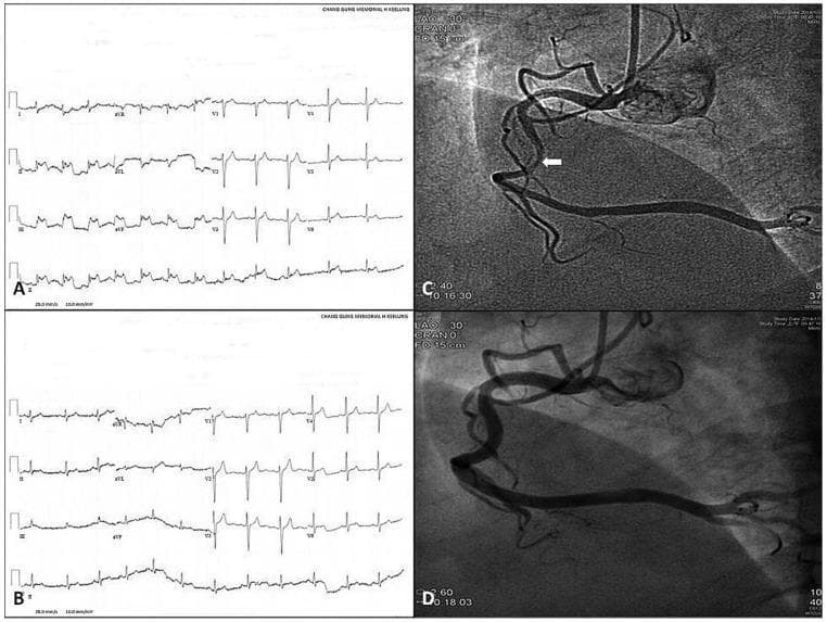A multi-panel medical image illustrating variant (Prinzmetal) angina diagnostic findings. Panels A and B display 12-lead electrocardiograms (ECG). Panel A shows significant ST-segment elevation in inferior leads II, III, and aVF during a symptomatic angina attack. Panel B shows the resolution of these ST-segment elevations following the administration of sublingual nitroglycerin. Panels C and D are coronary angiograms of the right coronary artery (RCA). Panel C reveals a focal, severe narrowing or vasospasm in the mid-portion of the RCA (indicated by a white arrow) induced by methylergonovine. Panel D demonstrates the complete relief of this coronary artery spasm (CAS) after treatment with intracoronary nitroglycerin, resulting in restored vessel patency and normal caliber. The composite image serves as a clinical comparison for medical students and clinicians to recognize the reversible nature of vasospastic angina through both electrical (ECG) and anatomical (angiography) evidence.